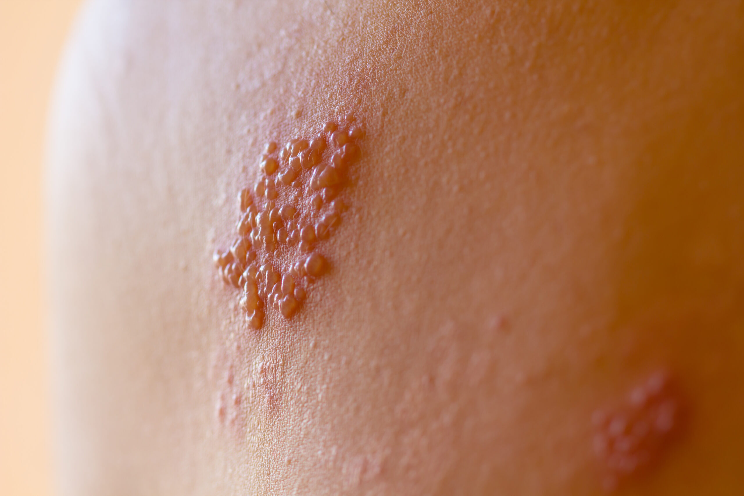 Herpes Zoster (Shingles)