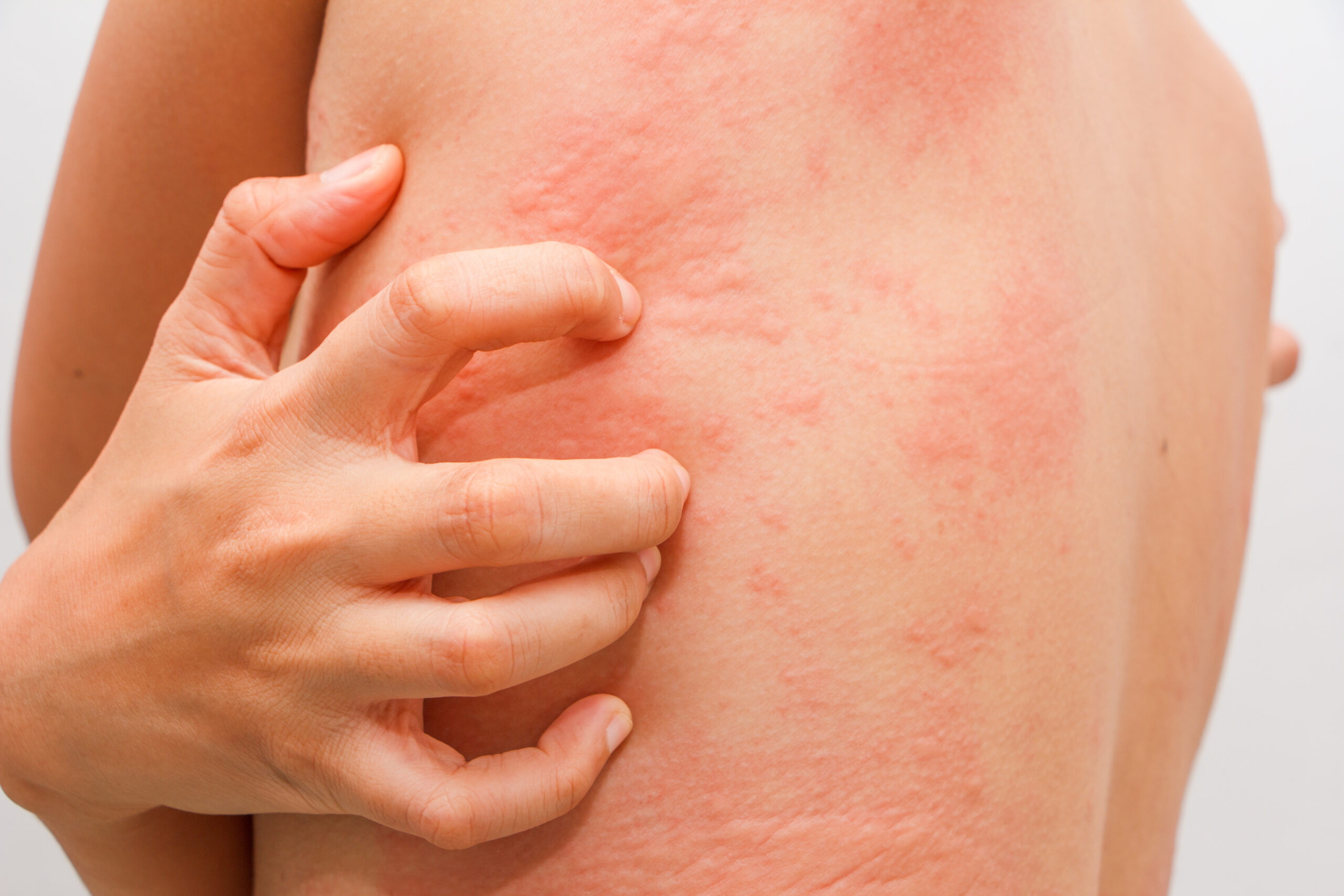 Rosacea