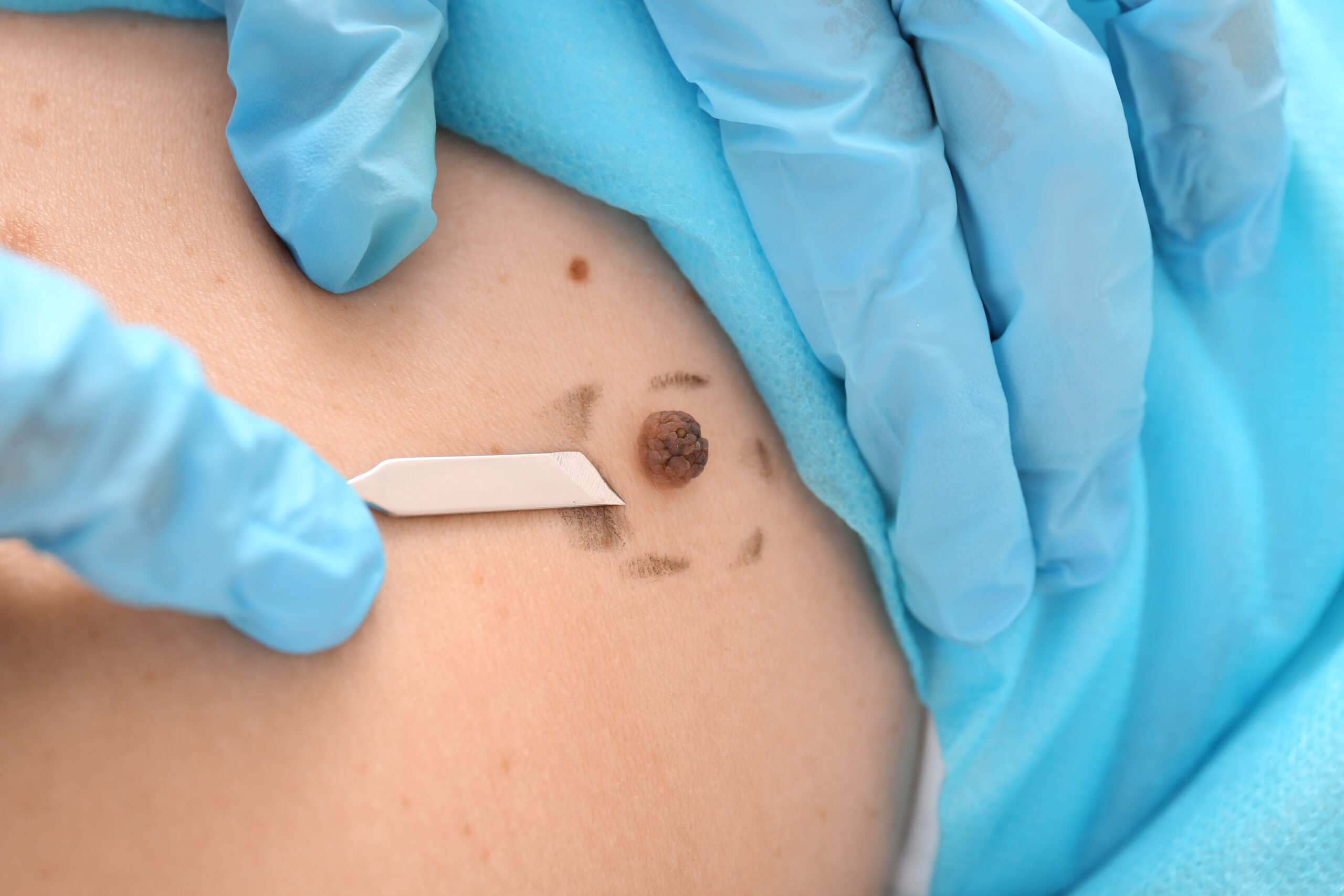 Surgical Excisions
