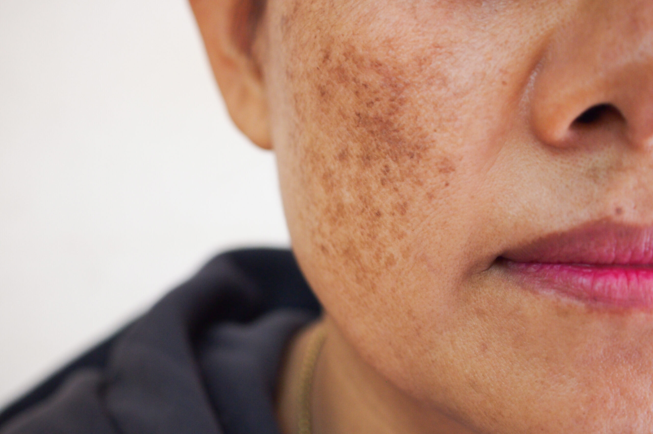 Treatment of Pigmented Spots