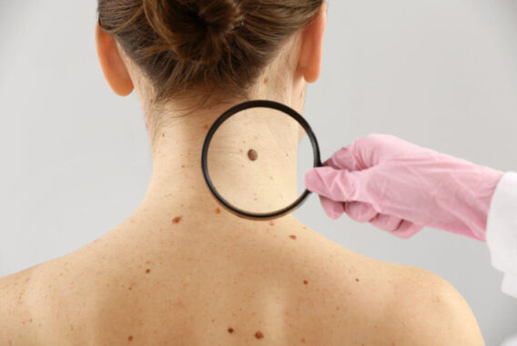 How to Know If Your Mole Is Suspicious