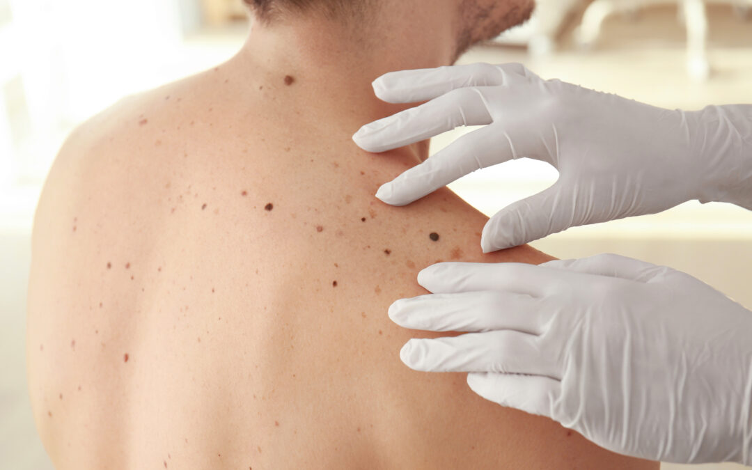 Skin Cancer Awareness Month: What You Need to Know About Melanoma