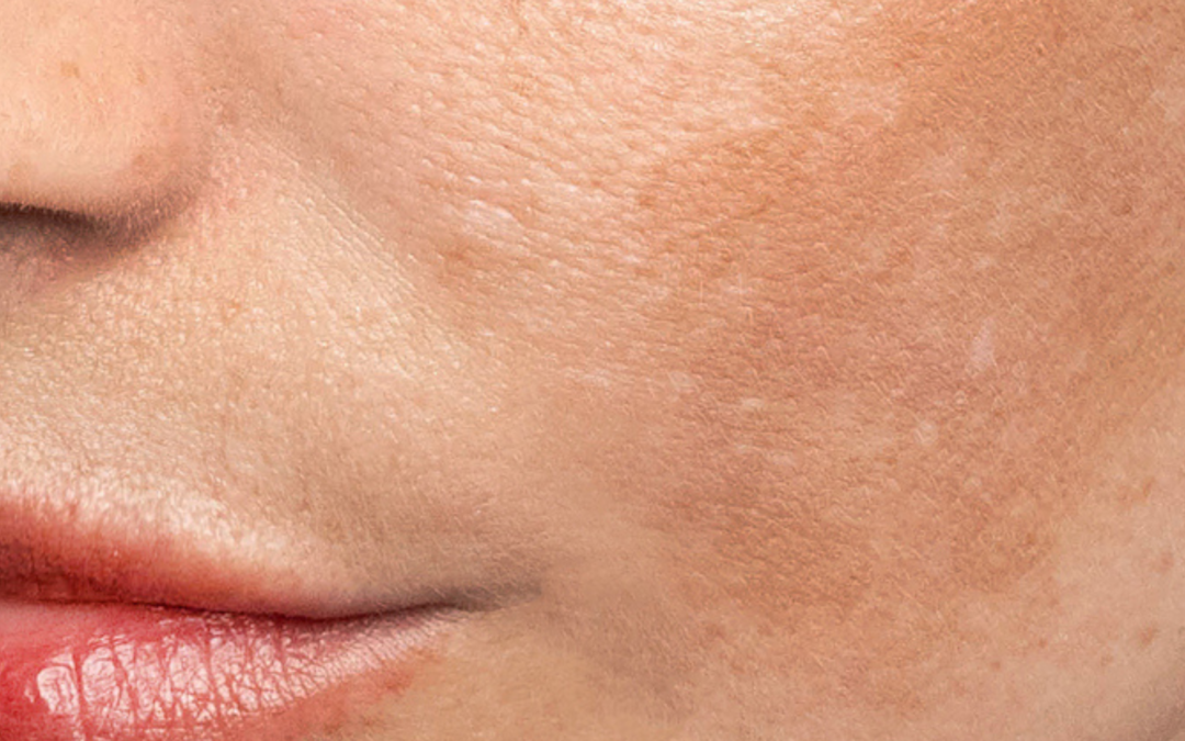 Melasma vs. Sun Spots vs. Age Spots: How to Tell Them Apart